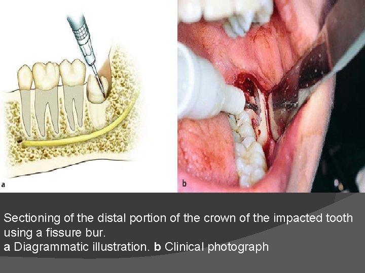 Sectioning of the distal portion of the crown of the impacted tooth using a
