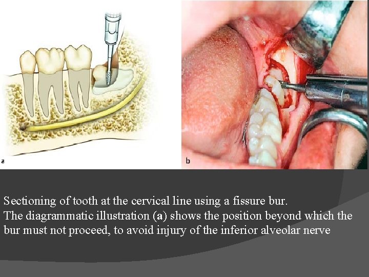 Sectioning of tooth at the cervical line using a fissure bur. The diagrammatic illustration