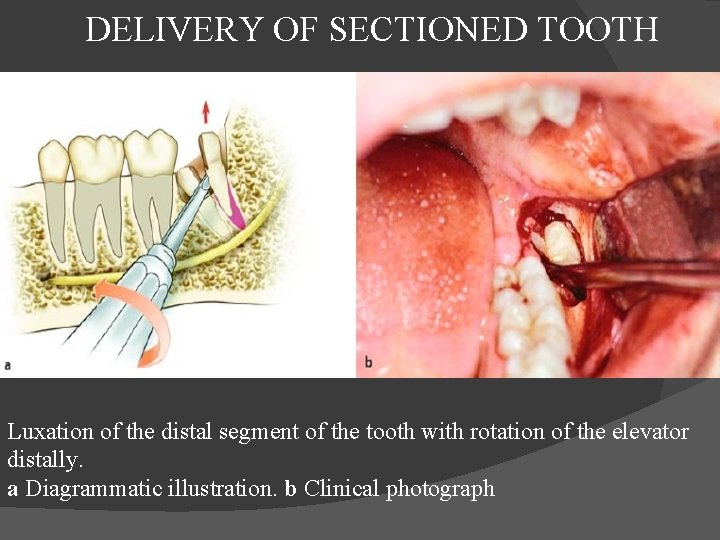  DELIVERY OF SECTIONED TOOTH Luxation of the distal segment of the tooth with