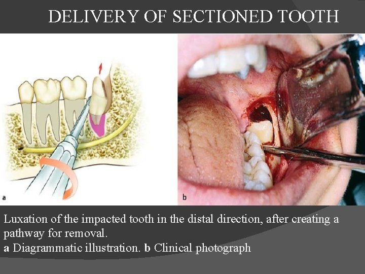  DELIVERY OF SECTIONED TOOTH Luxation of the impacted tooth in the distal direction,