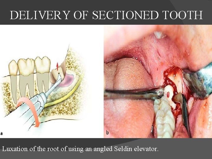  DELIVERY OF SECTIONED TOOTH Luxation of the root of using an angled Seldin