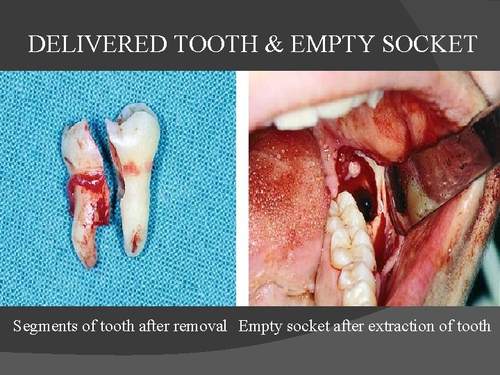  DELIVERED TOOTH & EMPTY SOCKET Segments of tooth after removal Empty socket after
