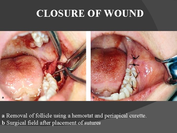 CLOSURE OF WOUND a Removal of follicle using a hemostat and periapical curette. b