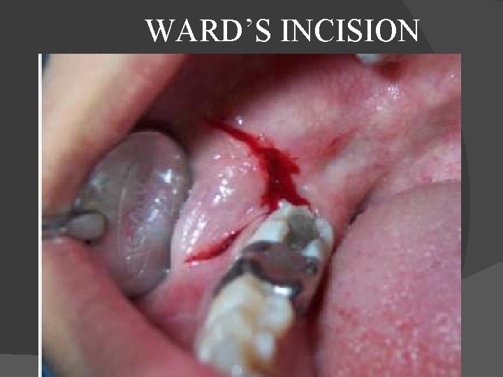  WARD’S INCISION 