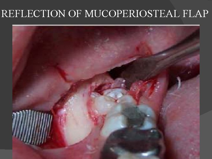 REFLECTION OF MUCOPERIOSTEAL FLAP 