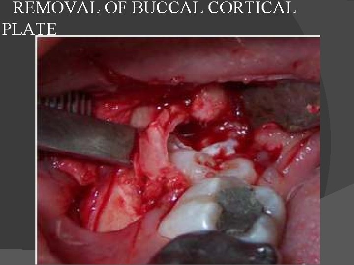  REMOVAL OF BUCCAL CORTICAL PLATE 