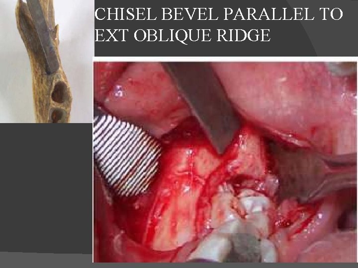 CHISEL BEVEL PARALLEL TO EXT OBLIQUE RIDGE 