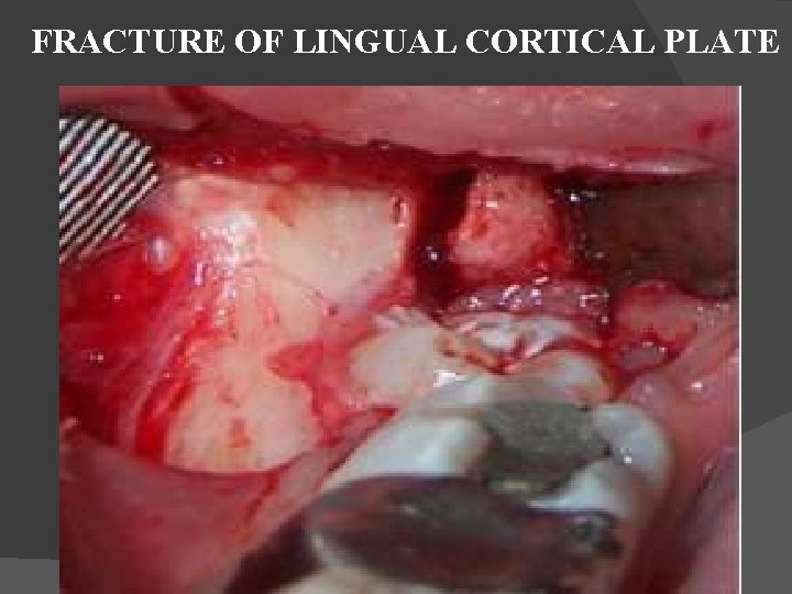  FRACTURE OF LINGUAL CORTICAL PLATE 