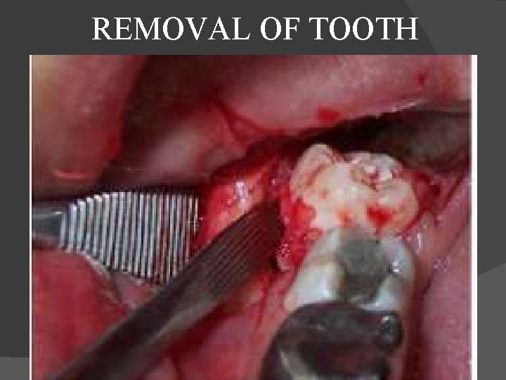  REMOVAL OF TOOTH 