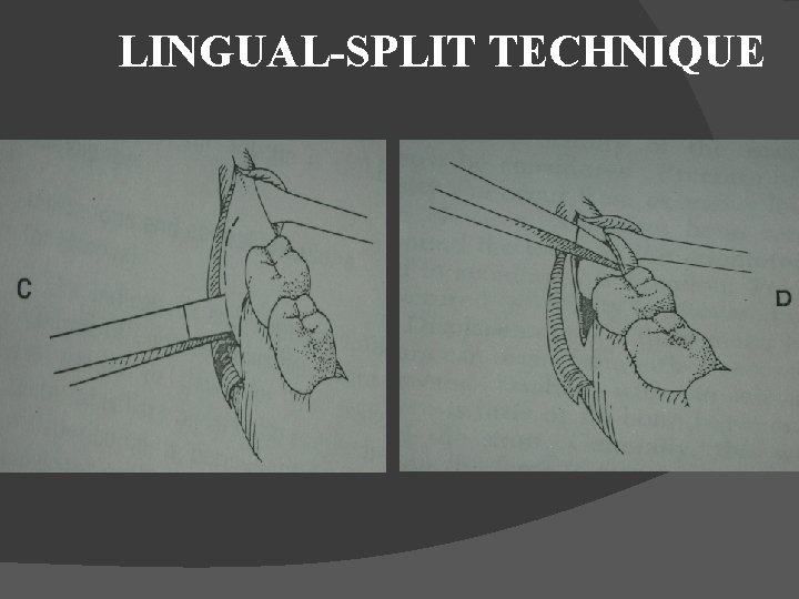 LINGUAL-SPLIT TECHNIQUE 