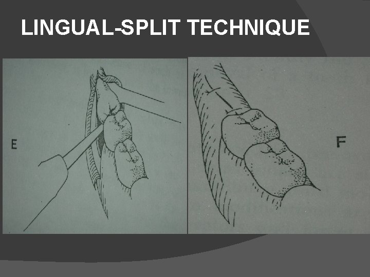 LINGUAL-SPLIT TECHNIQUE 