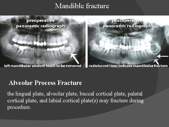 Mandible fracture Alveolar Process Fracture the lingual plate, alveolar plate, buccal cortical plate, palatal