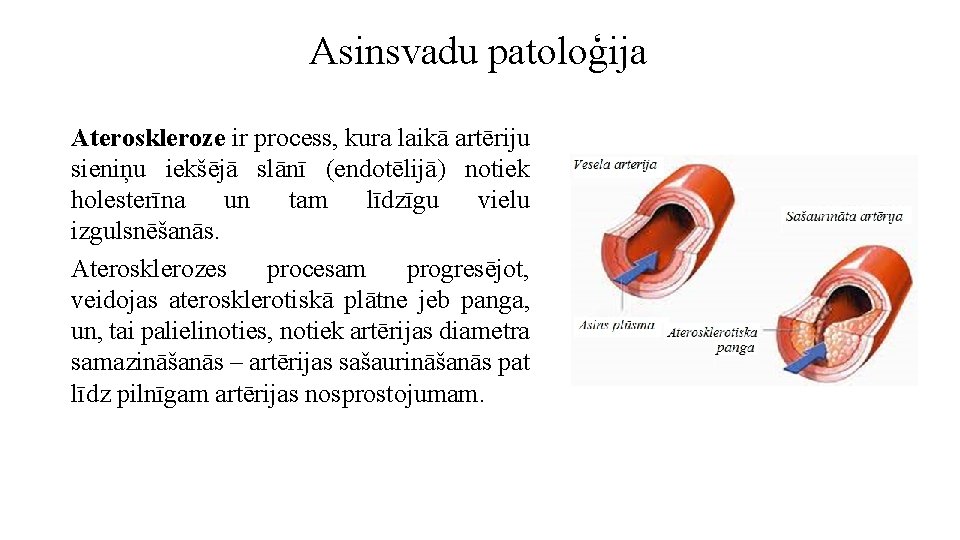 Asinsvadu patoloģija Ateroskleroze ir process, kura laikā artēriju sieniņu iekšējā slānī (endotēlijā) notiek holesterīna