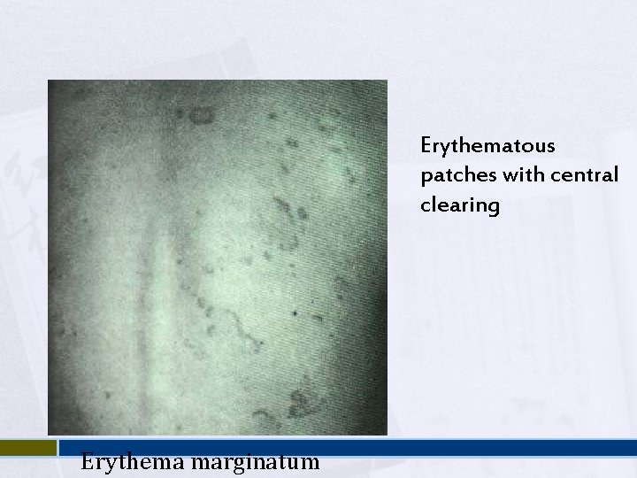 Erythematous patches with central clearing Erythema marginatum 