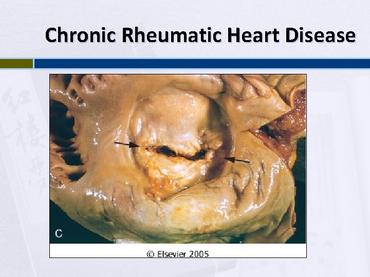 Chronic Rheumatic Heart Disease 