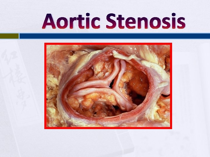 Aortic Stenosis 