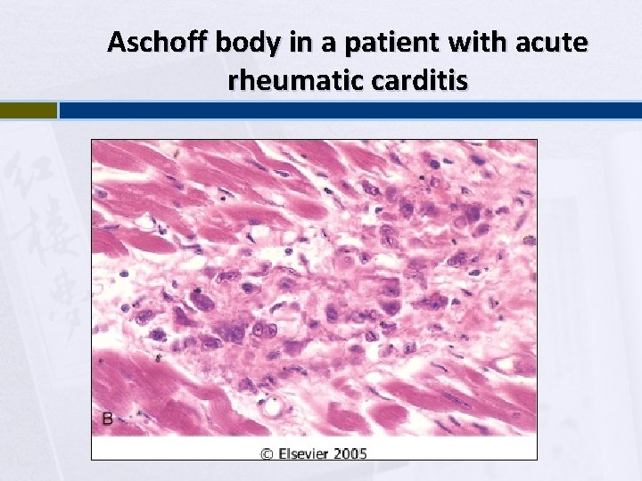Aschoff body in a patient with acute rheumatic carditis 