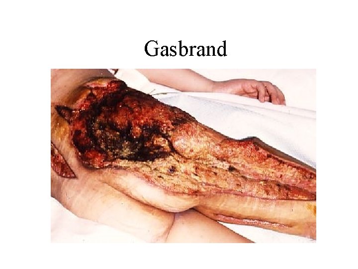 Gasbrand 