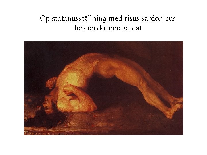 Opistotonusställning med risus sardonicus hos en döende soldat 