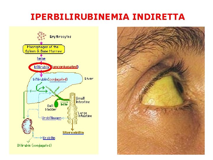 IPERBILIRUBINEMIA INDIRETTA (unconjugated) 