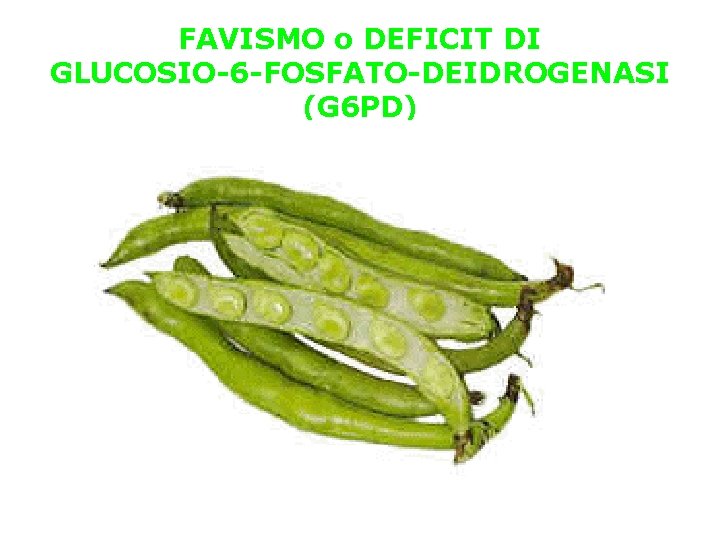 FAVISMO o DEFICIT DI GLUCOSIO-6 -FOSFATO-DEIDROGENASI (G 6 PD) 