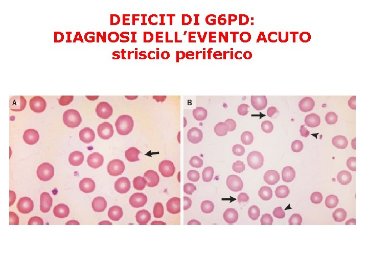 DEFICIT DI G 6 PD: DIAGNOSI DELL’EVENTO ACUTO striscio periferico 