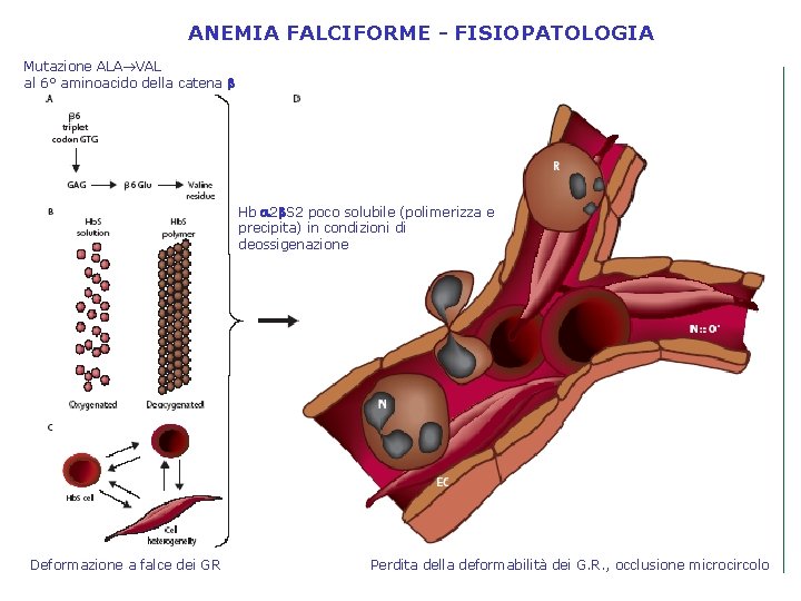 ANEMIA FALCIFORME - FISIOPATOLOGIA Mutazione ALA VAL al 6° aminoacido della catena b Hb