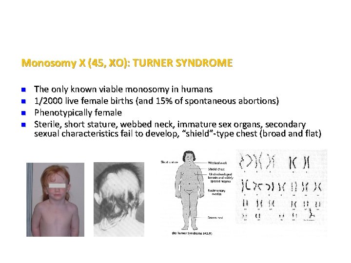Monosomy X (45, XO): TURNER SYNDROME n n The only known viable monosomy in