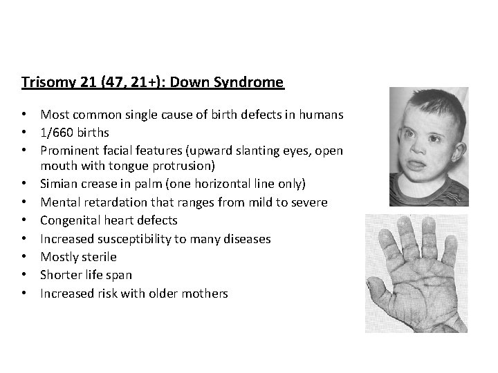 Trisomy 21 (47, 21+): Down Syndrome • Most common single cause of birth defects
