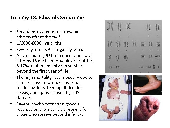 Trisomy 18: Edwards Syndrome • Second most common autosomal trisomy after trisomy 21. •