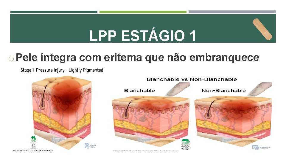 LPP ESTÁGIO 1 o Pele íntegra com eritema que não embranquece 