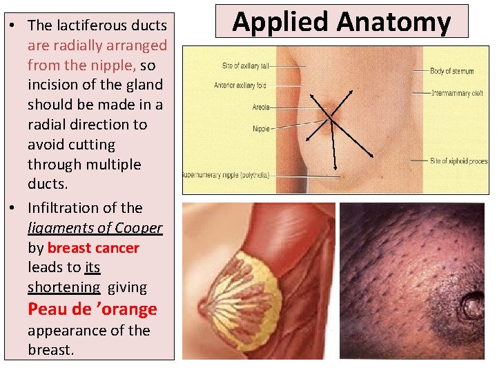  • The lactiferous ducts are radially arranged from the nipple, so incision of