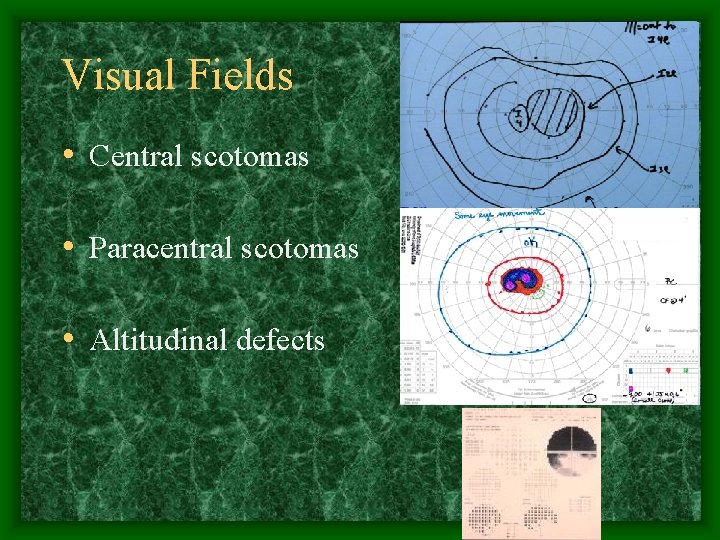 Visual Fields • Central scotomas • Paracentral scotomas • Altitudinal defects 