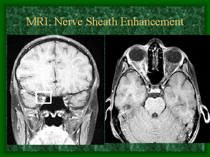 MRI: Nerve Sheath Enhancement • 