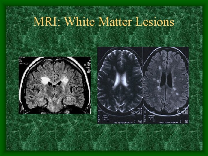 MRI: White Matter Lesions 