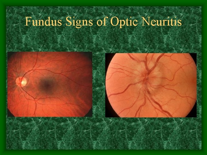 Fundus Signs of Optic Neuritis 