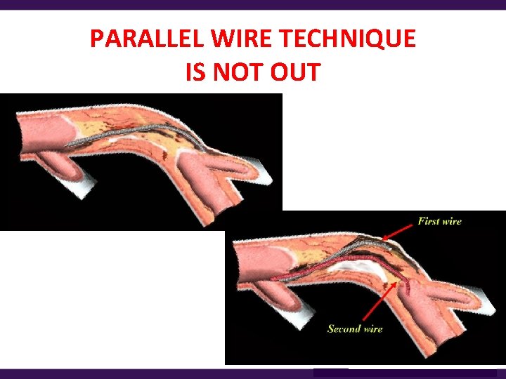PARALLEL WIRE TECHNIQUE IS NOT OUT 