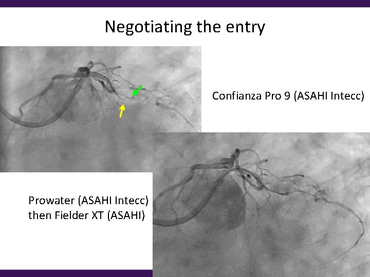 Negotiating the entry Confianza Pro 9 (ASAHI Intecc) Prowater (ASAHI Intecc) then Fielder XT