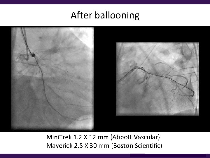 After ballooning Mini. Trek 1. 2 X 12 mm (Abbott Vascular) Maverick 2. 5