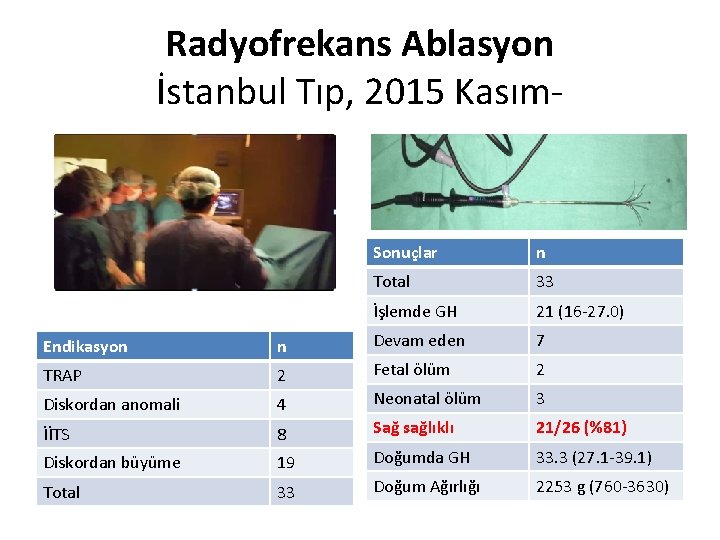 Radyofrekans Ablasyon İstanbul Tıp, 2015 Kasım‐ Sonuçlar n Total 33 İşlemde GH 21 (16‐