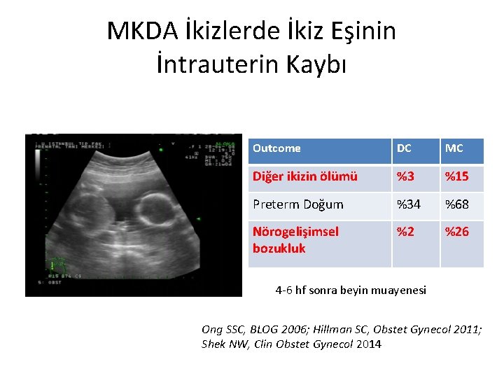 MKDA İkizlerde İkiz Eşinin İntrauterin Kaybı Outcome DC MC Diğer ikizin ölümü %3 %15