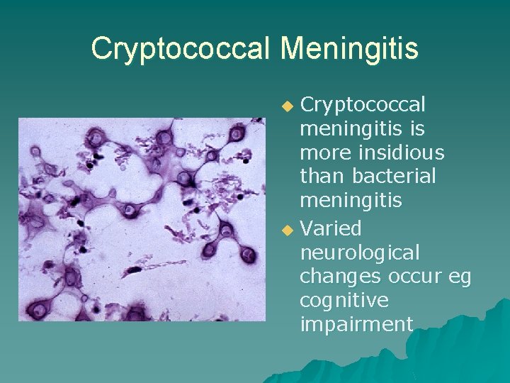 Cryptococcal Meningitis Cryptococcal meningitis is more insidious than bacterial meningitis u Varied neurological changes