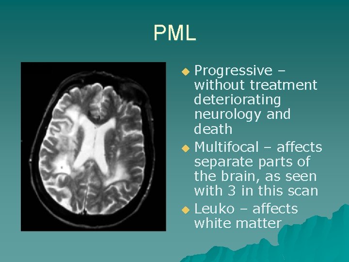 PML Progressive – without treatment deteriorating neurology and death u Multifocal – affects separate