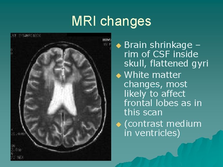 MRI changes Brain shrinkage – rim of CSF inside skull, flattened gyri u White