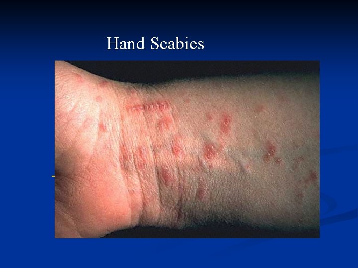 Hand Scabies 