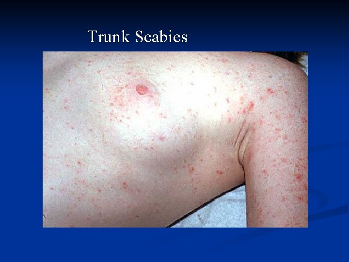 Trunk Scabies 