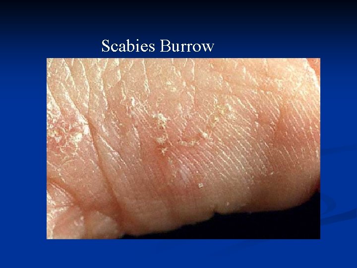 Scabies Burrow 