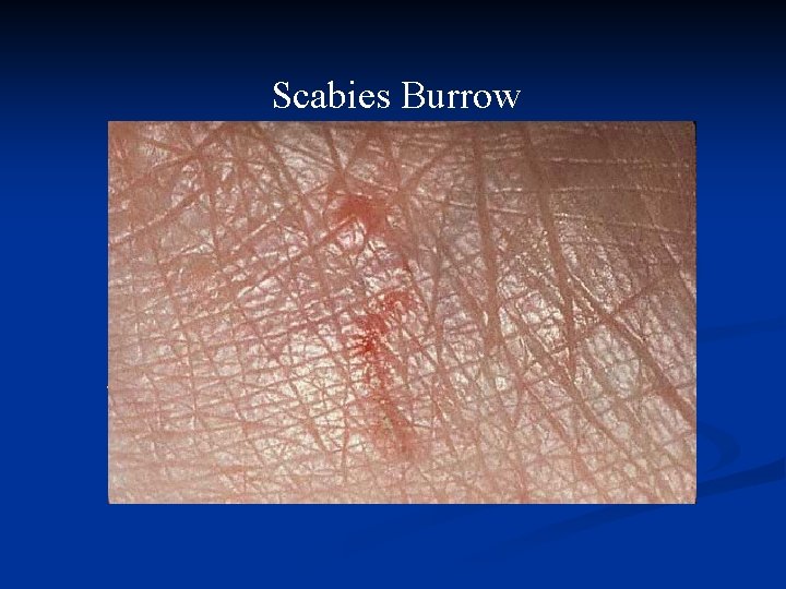 Scabies Burrow 