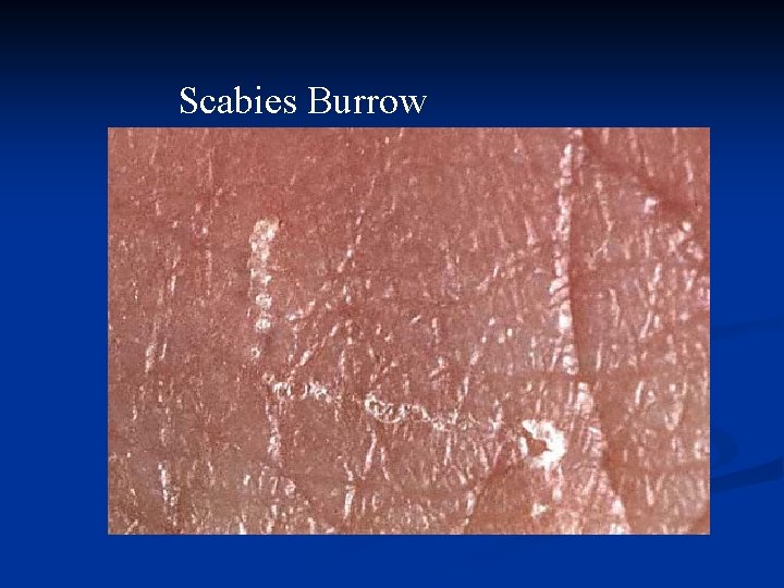 Scabies Burrow 