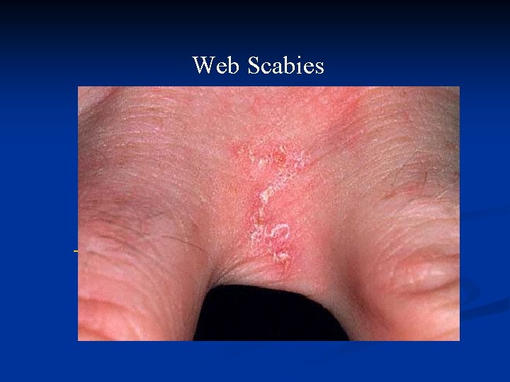 Web Scabies 